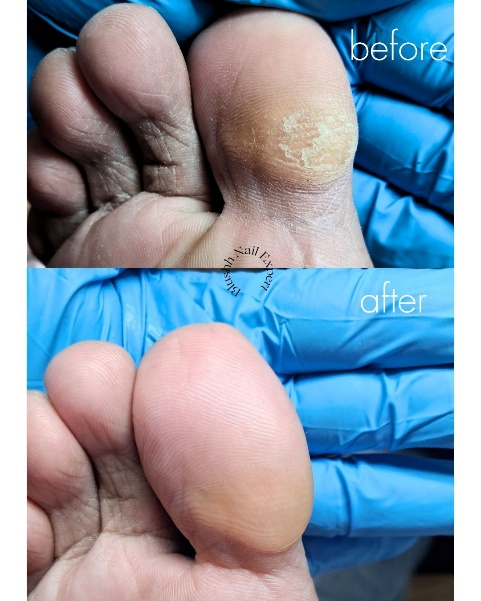 Before and after — severe callus with smooth restoration