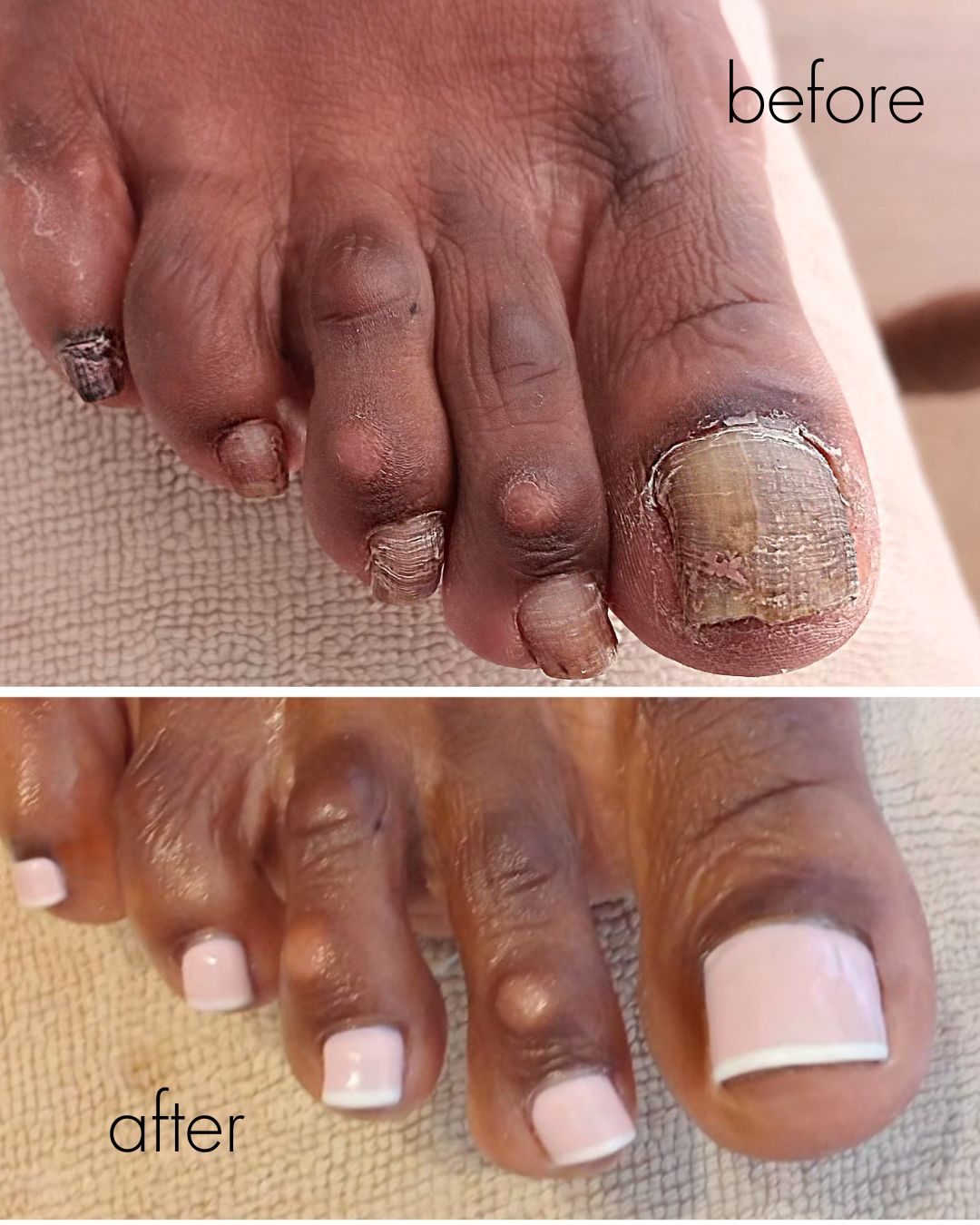 Before and after — inflamed toe corrected with a refined off-white finish