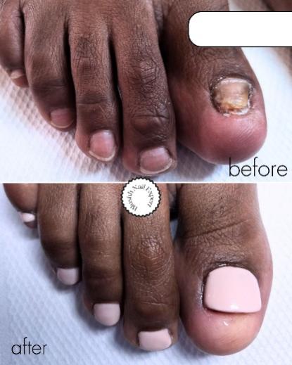 Before and after — damaged nail with clean reconstruction