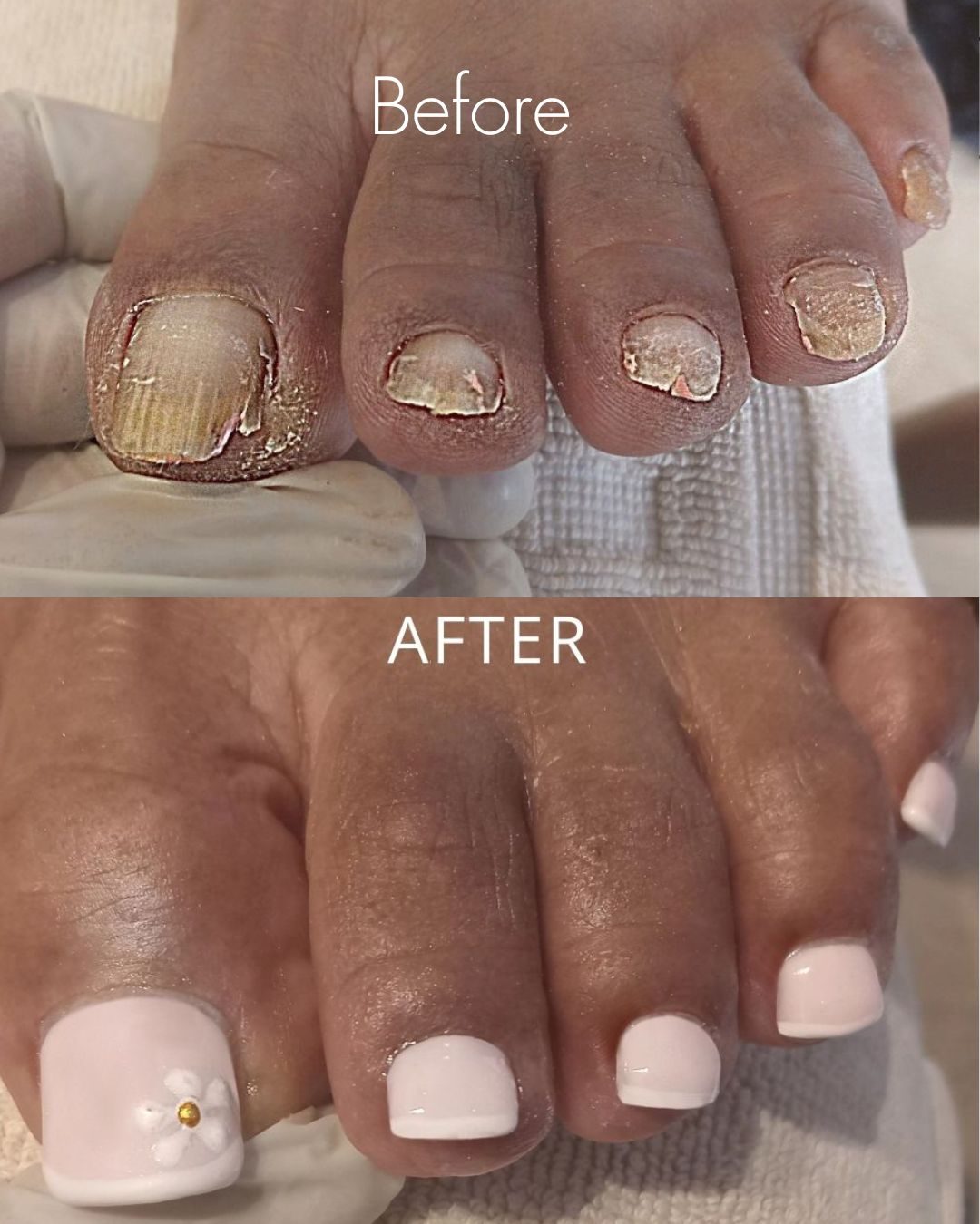 Before and after — fungal nails reconstructed with a white finish and flower accent