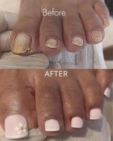 Before and after — severely damaged nails with full restoration