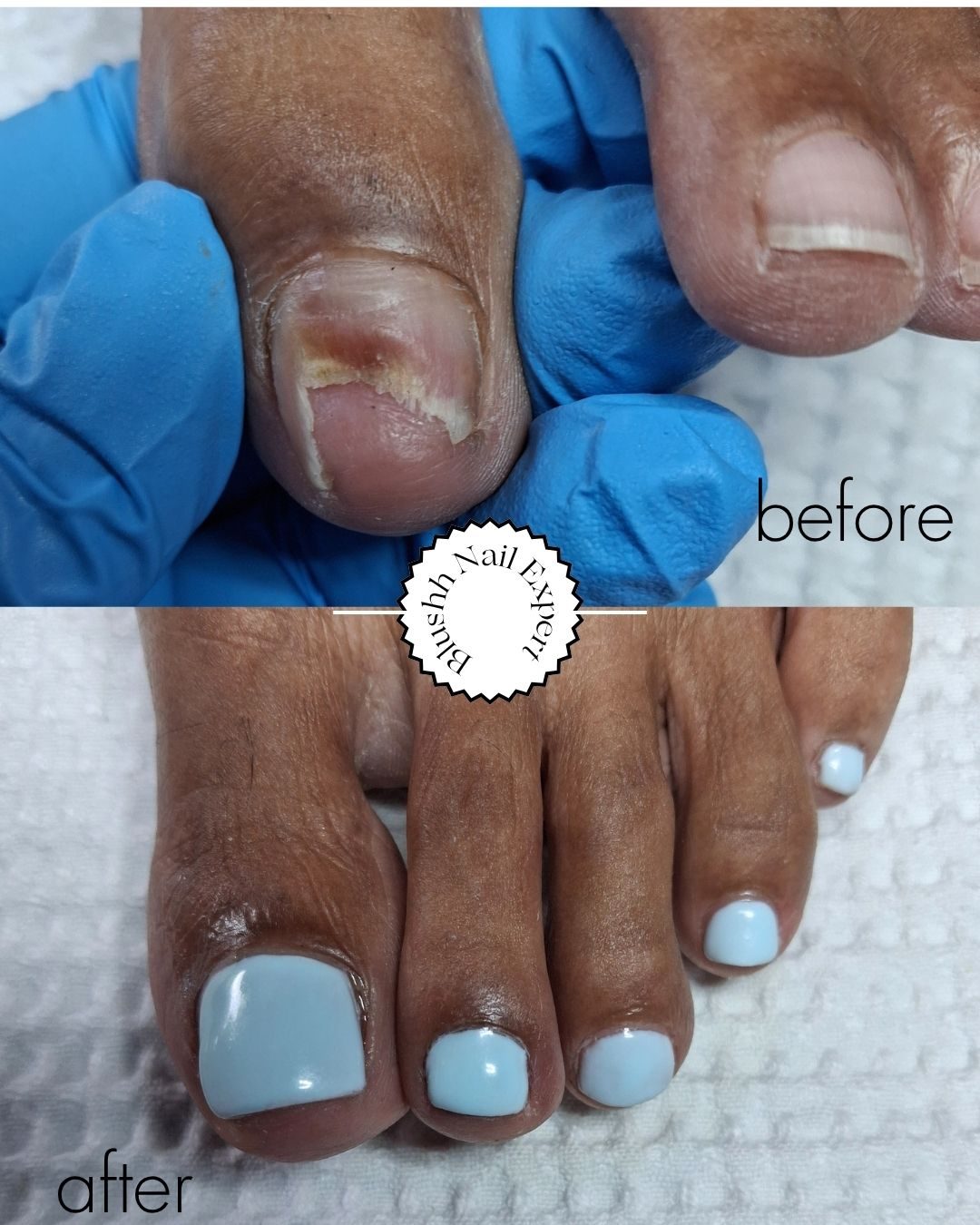 Before and after — cracked nail corrected with a soft blue pedicure