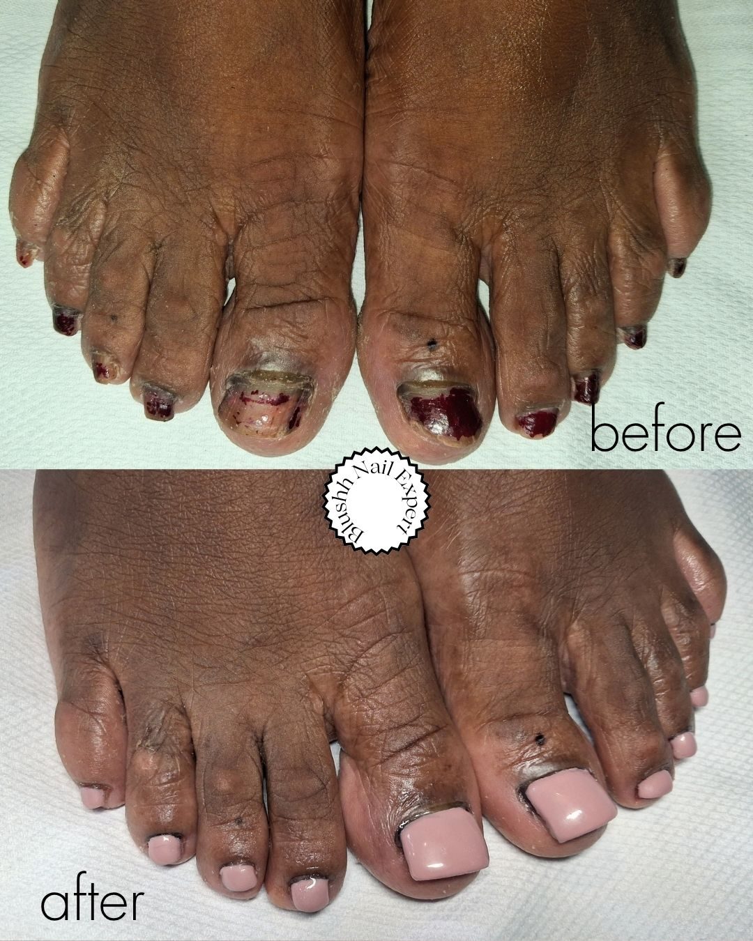 Before and after — traumatised toes restored with a soft mauve pedicure
