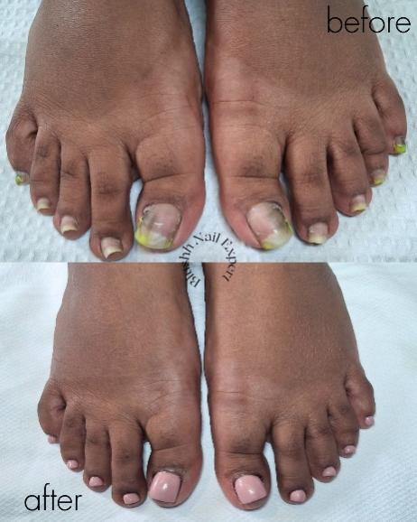 Before and after — neglected feet with total transformation