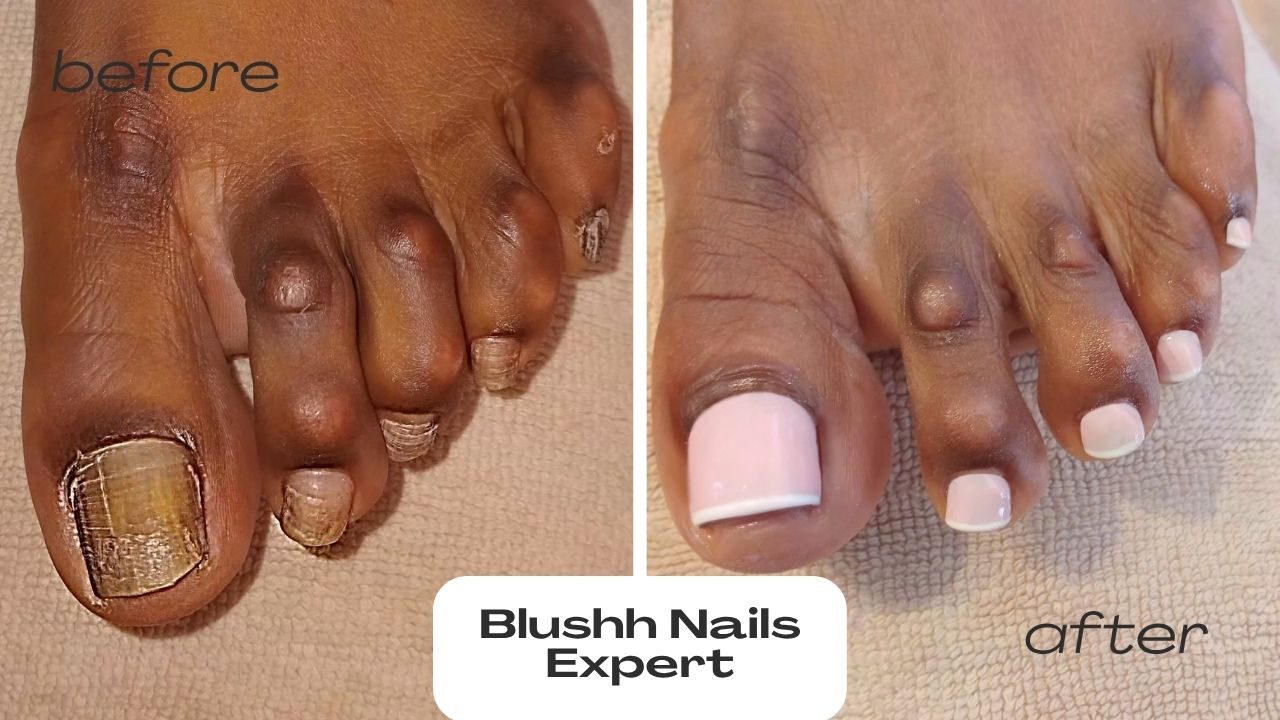 Before and after — yellow fungal nail corrected with a pink and white French pedicure
