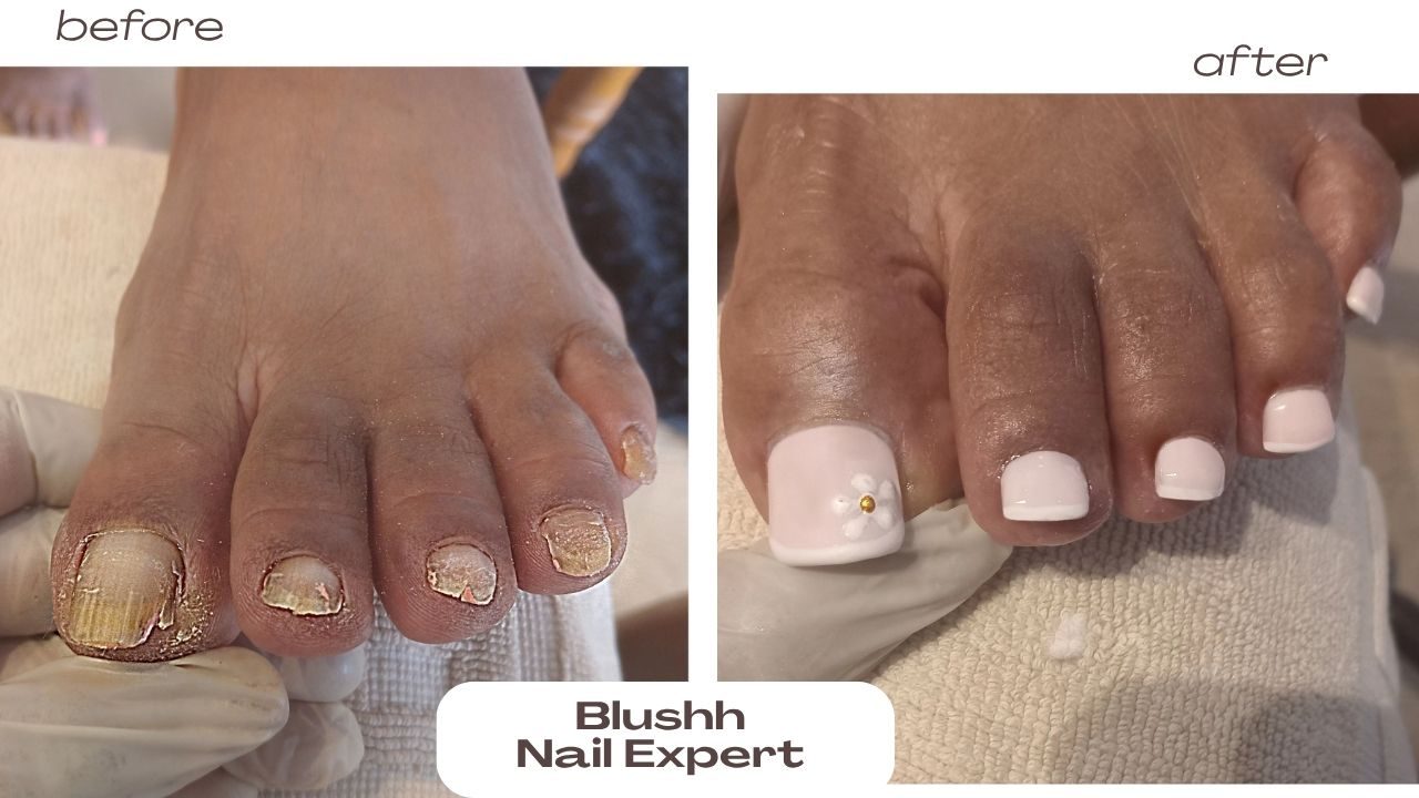 Before and after — damaged nail reconstructed with a white finish and flower accent